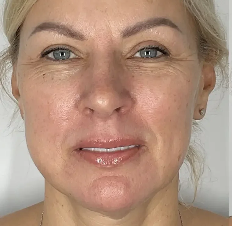 Full_face_contouring_non_surgical_face_lift._liquid_face_lift_-_before_and_after_2_c1e897ef-6a4f-4cc8-81c8-60f65f547711