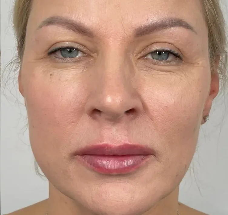 Full_face_contouring_non_surgical_face_lift._liquid_face_lift_-_before_and_after_2_c1e897ef-6a4f-4cc8-81c8-60f65f547711